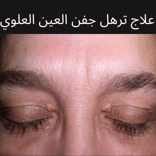 علاج ترهل جفن العين العلوي ومدي جدوي عمليات الشد