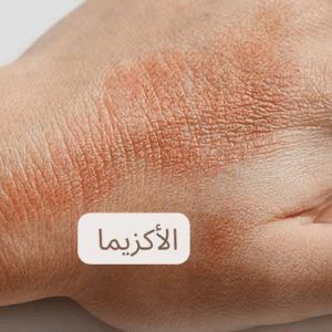  طرق علاج حساسية الجلد بأنواعها ال 4 الشهيرة والوقاية منها