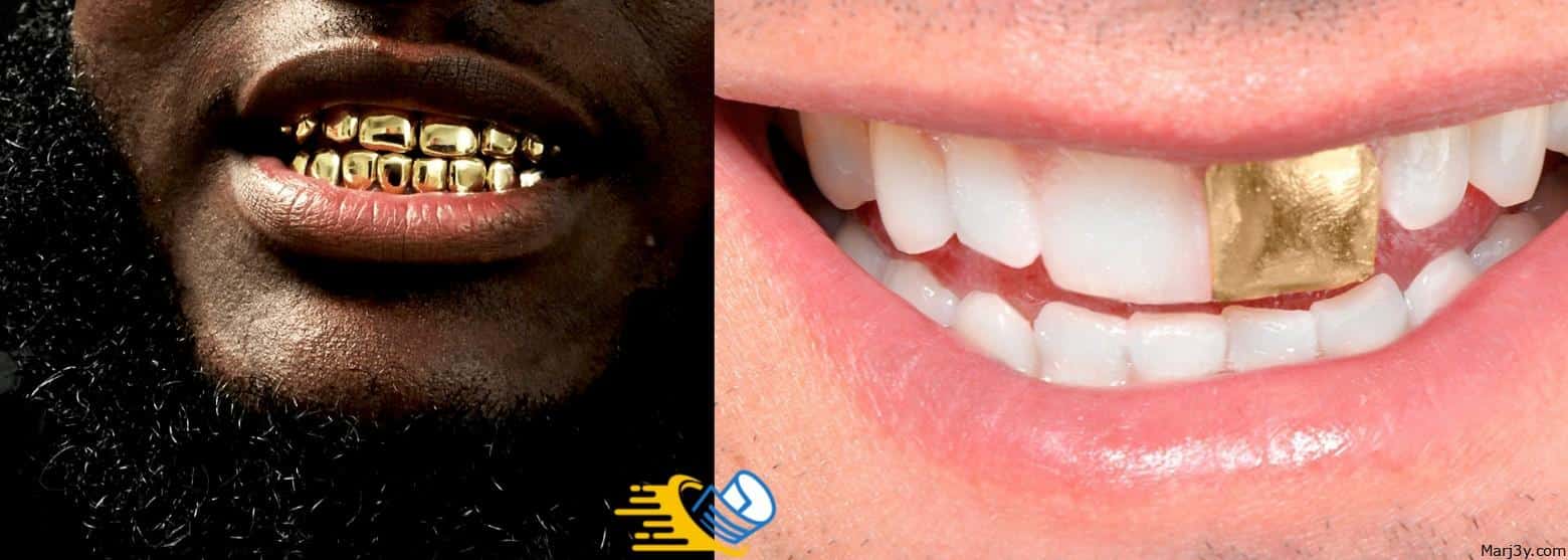 الاسنان الذهبية 