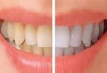 وصفة لتبيض الاسنان من الصفار