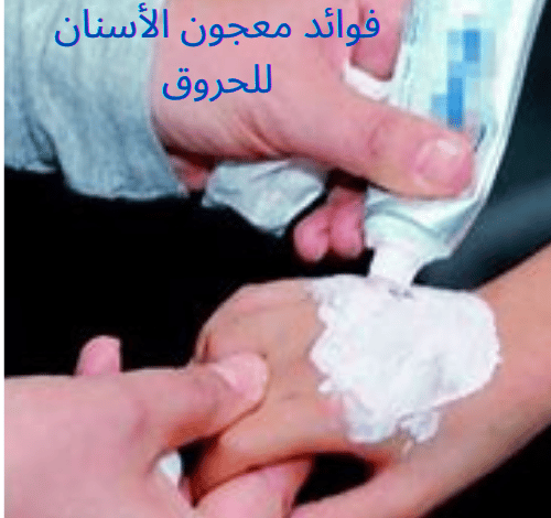 فوائد معجون الأسنان للحروق