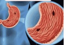 أعراض قرحة المعدة و 4 طرق للتخلص منها نهائياً