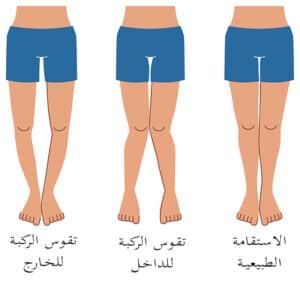 8 حلول سحرية لمشكلة لين العظام وعلاقته بفيتامين د