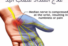 5 نقاط حول علاج انسداد عصب اليد وجراحة تسليك الأعصاب