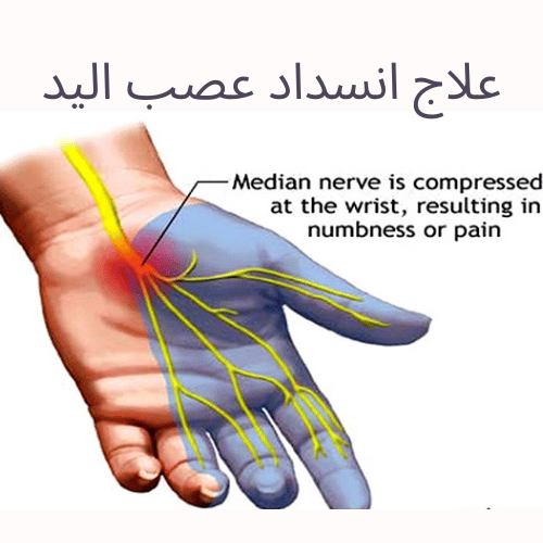 5 نقاط حول علاج انسداد عصب اليد وجراحة تسليك الأعصاب