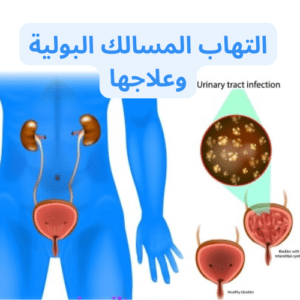 5 عوامل خطر لالتهاب المسالك البولية وعلاجها والوقاية منه