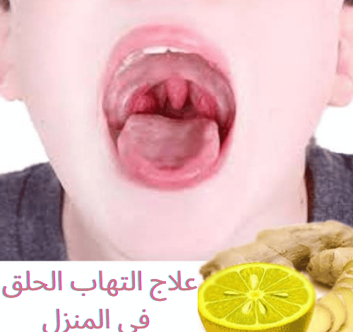 أسهل 6 طرق لعلاج التهاب الحلق في المنزل والوقاية منه