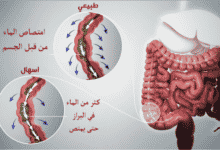 3 خطوات لعلاج الإسهال وإيقافه نهائياً