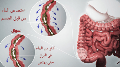 3 خطوات لعلاج الإسهال وإيقافه نهائياً