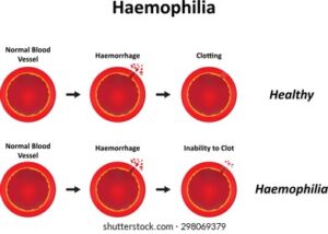 الهيموفيليا