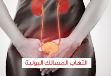 5 عوامل خطر لالتهاب المسالك البولية وعلاجها والوقاية منه