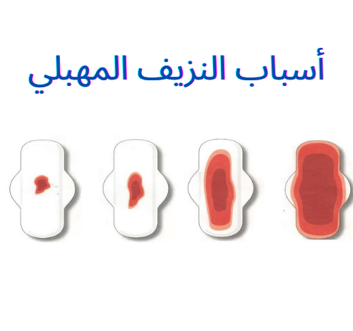 أسباب النزيف المهبلي وكيفية إيقافه وعلاجه