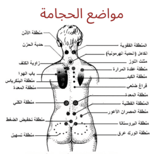 12 سر من أسرار الحجامة ومدي فاعليتها