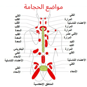 الأمراض التي تعالجها الحجامة