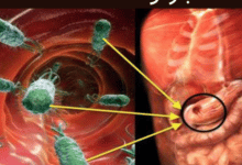 التخلص من جرثومة المعدة نهائياً خلال 3 أسابيع