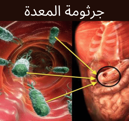 التخلص من جرثومة المعدة نهائياً خلال 3 أسابيع