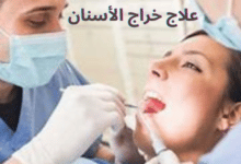 علاج خراج الأسنان