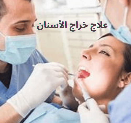 علاج خراج الأسنان