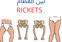 8 حلول سحرية لمشكلة لين العظام وعلاقته بفيتامين د