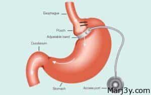 جراحة تدبيس المعدة