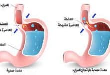 أشهر دواء ارتجاع المرئ في الصيدليات