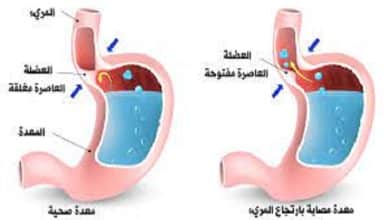 أشهر دواء ارتجاع المرئ في الصيدليات