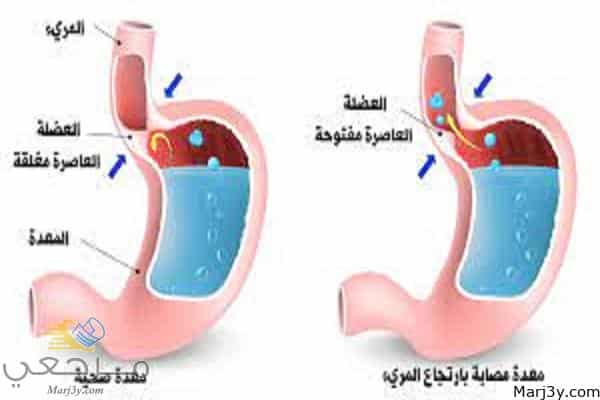 دواء لارتجاع المرئ