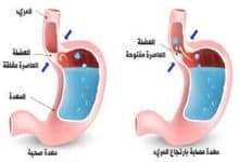 دواء لارتجاع المرئ