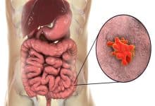 وصفة لعلاج الاميبا عند الاطفال