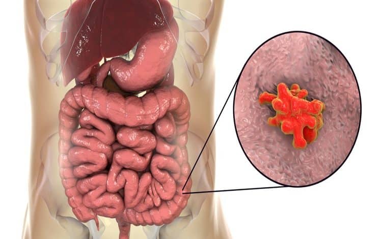 وصفة لعلاج الاميبا عند الاطفال